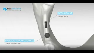 IMPLANTOLOGIE - REX PIEZOIMPLANT - Schmaler Kieferkamm? Problem gelöst.