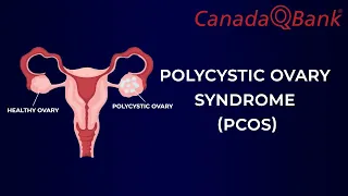 Polycystic Ovary Syndrome (PCOS)