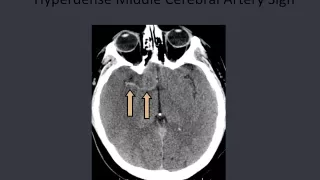 BATs: Assessment of Acute Stroke