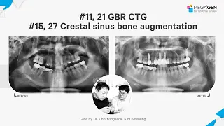Dr. Yongseok CHO, Sewoung KIM, #15, 27 CSBA, #11, 21 GBR CTG  surgery and prosthesis