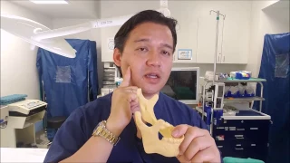 Feminizing Mandible Contouring - V-line Jaw Surgery - Dr. Keojampa