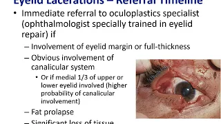 Trauma of the Periocular Structures