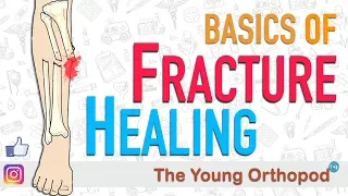 Fracture Healing | ANIMATION | BASICS | The Young Orthopod