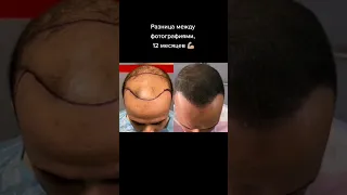 12 месяцев после пересадки волос. Пересадка волос в Турции
