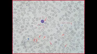 Hemograma de paciente com Talassemia