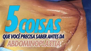 5 COISAS QUE VOCÊ PRECISA SABER ANTES DE FAZER ABDOMINOPLASTIA? CIRURGIA PLASTICA