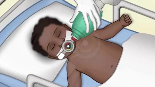 "General Ventilator Set-up" by Nancy Craig for OPENPediatrics