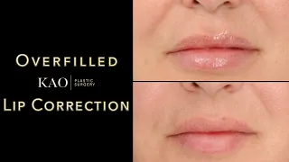 The Overfilled Lip Epidemic! Contoured Correction - Shaping Beautiful Lips - KAO Plastic Surgery