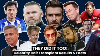 THEY DID IT TOO! | Celebrity Hair Transplant Results & Facts | SMILE HAIR CLINIC