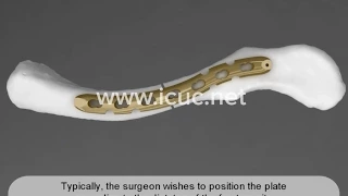 Precontoured plate in clavicle fractures