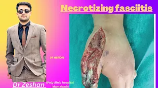 Necrotizing Fasciitis . Everything You Need To Know