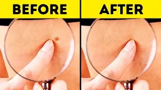 10 Effective Ways to Remove Skin Tags Naturally