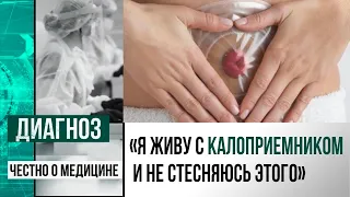 Стома – не приговор: как жить, если удалён кишечник? | Диагноз