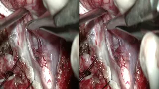 Foramen Magnum Meningioma