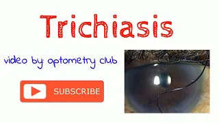 Trichiasis; eyelid abnormality - Optometry Club