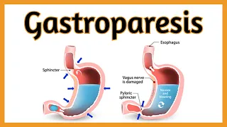 Gastroparesis