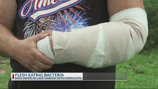 Man nearly loses arm to flesh eating bacteria