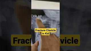 Fracture Clavicle in Kid...Dr Sai Chandra MBBS DNB Ortho