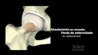 Impacto femoroacetabular tipo came animação 3D