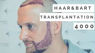 Hair transplant and Beard transplant in Istanbul Testimonial