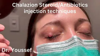 Chalazion Easiest and simplest Treatment with Steroid and Antibiotic Injections