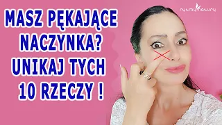 Masz Pękające Naczynka, Pajączki na Nogach? Unikaj tych 10 Rzeczy!