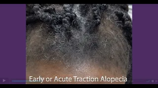 Traction Alopecia or Thinning on the Edges From Tight Braiding.