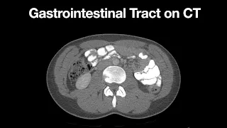 Anatomy of the Gastrointestinal System on CT