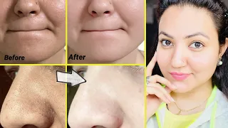 कितने भी मुश्किल Blackheads Whiteheads कील सफेद दाने हों, follow करें ये 5 steps और पाएँ चमकदार skin