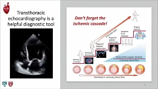 Acute Coronary Syndrome Update 2022, ACS Update