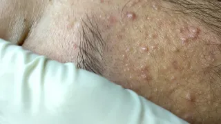 Acne Treament Under The Skin #043