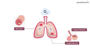 Was ist eine chronisch obstruktive Lungenerkrankung (COPD)?