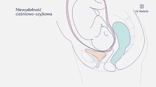 Jaki pessar stosować przy niewydolności szyjki macicy?