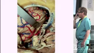 Far Lateral Crainotomy with Exposure of Lower Clivus & Vertebral-Basilar Junction