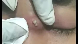 Warning: Remove big blackheads so danger