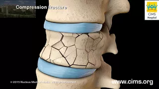 Vertebroplasty and Kyphoplasty - CIMS Hospital