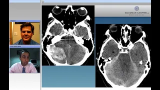 Infratentorial Arteriovenous Fistulas: Nuances of Technique for Microsurgical Ligation (Preview)