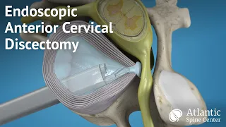 Endoscopic Anterior Cervical Discectomy