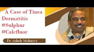 Dr Ashok Mohanty explaining a case of #Tinea dermatitis #sulphur #calcfluor