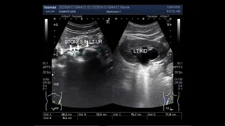 Ultrasound Video showing Multiple stones in the ureter.