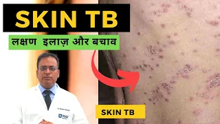 Skin TB लक्षण  इलाज़ और बचाव