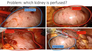 Bay Vision Virtual Meetup -- AI-Assisted Surgery: Perspectives and Challenges