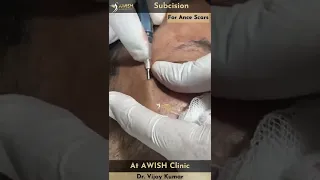 Subcision Treatment for Acne scars by Dr. Vijay Kumar at AWISH CLINIC #acnescars #subcision #shorts