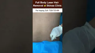 Full body Laser hair Removal at skinaa clinic #shorts