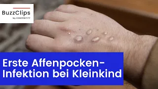 Erste Affenpocken-Infektion bei Kleinkind bestätigt