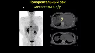 Сухов В.Ю. «Роль ПЭТ-КТ в диагностике онкологической патологии ЖКТ»