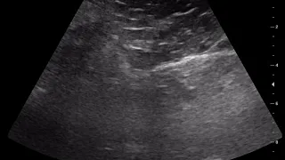 CASE 881 RIGHT GLUTEAL SUBCUTANEOUS CELLULITIS WITH ABSCESS FORMATION