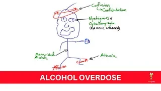 Acute Alcohol Intoxication