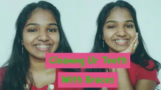 How To Clean Your Teeth With Braces | Malayalam #shorts #youtubeshorts