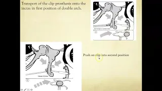 Otosclerosis - Excerpts of Educational Video by World ENT Care (Dr. Mehak Agarwal)